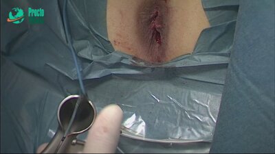 Гарманова Т.Н. - Иссечение хронической анальной трещины