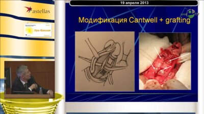 Рудин Ю.Э. "Этапное лечение экстрофии мочевого пузыря у детей"