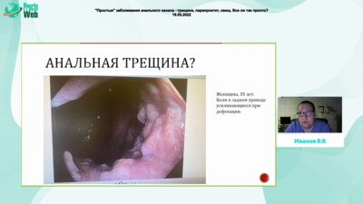 Иванов В.В. - Реальная клиническая практика - как все бывает обманчиво в колопроктологии