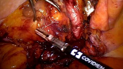 Laparoscopic prostatectomy assistant education LIVE _ Простатэктомия обучение ассистента