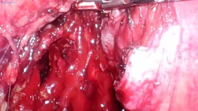 Laparoscopic radical cystectomy Bricker LIVE _ Радикальная цистэктомия деривация