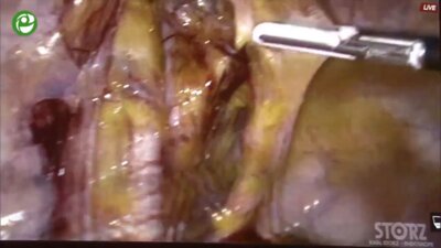 Laparoscopic Radical cystprostatectomy with intracorporeal orthotopic ileal neob