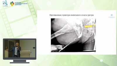 Чиненов Д.В. - Многоэтапная уретропластика