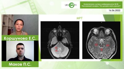 Вебинар. Клинические случаи в нейроурологии №18. Рассеянный склероз. Что должен знать уролог?