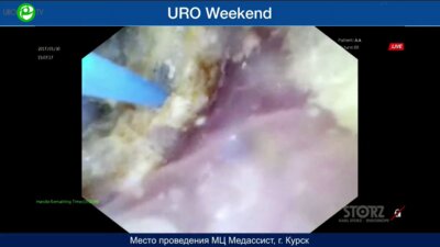 Сорокин Н.И. - Ретроградная гибкая интраренальная пиелолитотрипсия (Fiberlase U3, Innovex)