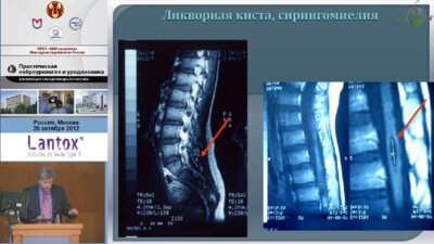 Николаев С.Н., Меновщикова Л.Б. "Опыт лечения и реабилитации детей раннего возраста с синдромом миелодисплазии."