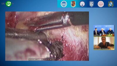 Галлямов Э.А. - Лапароскопическая простатэктомия (видеооперация)