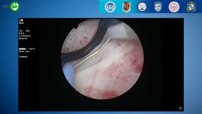 Севрюков Ф.А. - Трансуретральная биполярная плазменная энуклеация аденомы простаты (видеооперация)