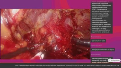 Операция 3. Лапароскопическая нервосберегающая простатэктомия