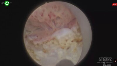 Дымов А.М. - Низкомощная энуклеация гиперплазии простаты, лазерная резекция мочевого пузыря EN BLOC