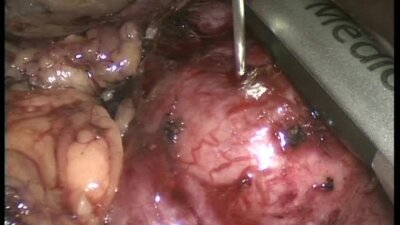 Криоаблация почки