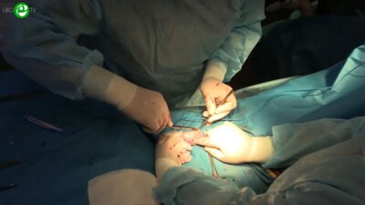 Операционная секция 6. Еркович А.А. - Заместительная корпоропластика полового члена