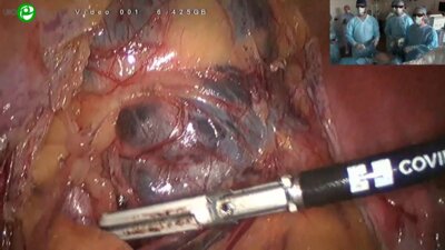 Галлямов Э.А. - Лапароскопическая лимфодиссекция метастазов адренокортикального рака