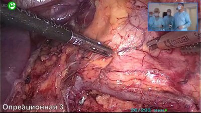 Галлямов Э.А. - Лапароскопическая 2-сторонняя резекция почек