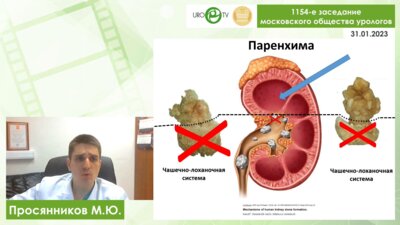 Просянников М.Ю. - Патогенетически обоснованная метафилактика мочекаменной болезни