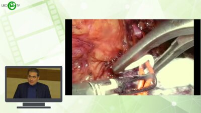 Кочкин А.Д. - Лапароскопичекая хирургия коралловидного нефролитиаза