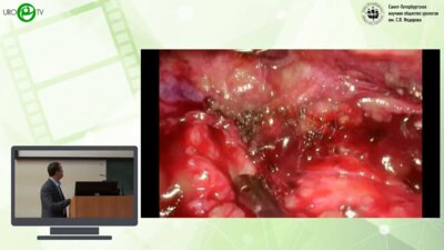 Вязовцев П.В. - Клинический случай. Радикальная нефруретерэктомия осложненная кровотечением из общей подвздошной артерии