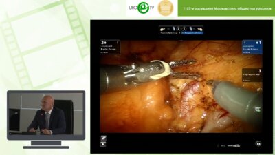 Абоян - Робот-ассистированная резекция внутрисинусной опухоли почки