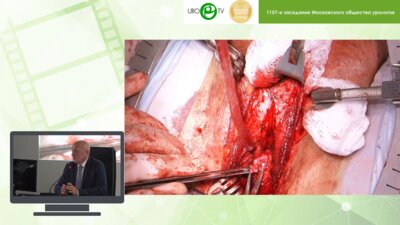 Даренков С.П. - Уретроуретроанастамоз