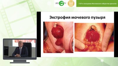 Даренков С.П., Коварский С.Л., Захаров А.И. - Коррекция удерживающего механизма континентной стомы у больных с замкнутым мочевым резервуаром