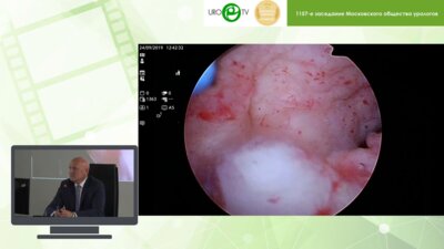 Кочкин А.Д. - Лапароскопическая коррекция редкого осложнения ТУР простаты