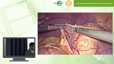 Соколов А.А. - Лапароскопическая резекция левой почки по поводу опухоли более 4 см