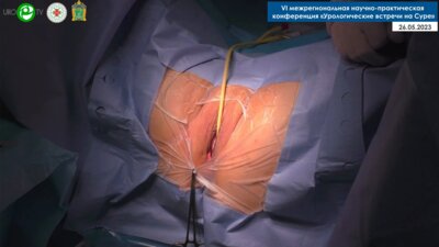 Миронов М.А. - Установка нового субуретрального женского слинга I-STOP