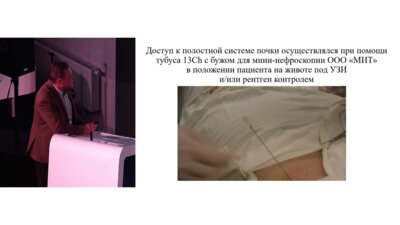 Ляшенко В.В. - Безнефростомная мини-перкутанная нефролитотрипсия