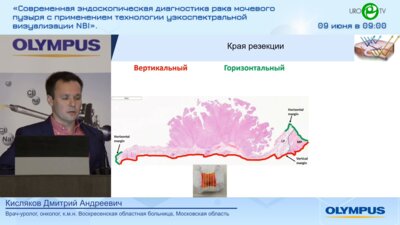 Кисляков Д.А. - Контроль края резекции при трансуретральном удалении опухолей мочевого пузыря
