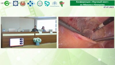 Безруков Е.А. - Лапароскопическая аденомэктомия