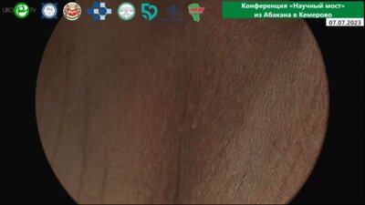 Филимонов В.Б. - Имплантация мужского слинга