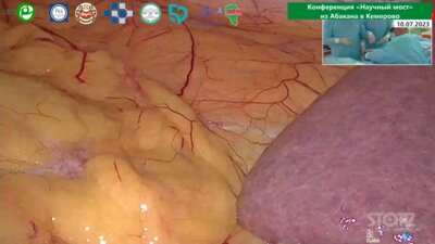 Безруков Е.А. - Лапароскопическая резекция почки с ICG