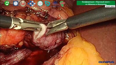 Новиков А.Б. - Лапароскопическая пластика ЛМС