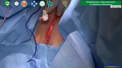 Кызласов П.С. - Имплантация мужского слинга