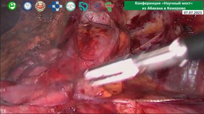 Помешкин Е.В. - Лапароскопическая резекция почки