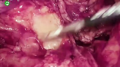 Галлямов Э.А. - Лапароскопическая радикальная цистпростатвезикулэктомия с формированием ортотопического мочевого резервуара