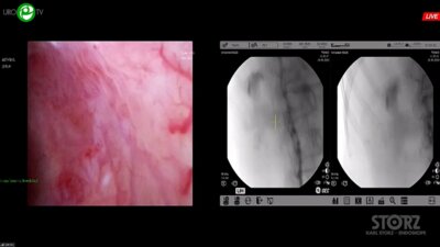 Мартов А.Г. - Комбинированная интраренальная хирургия с использованием технологии микроперк