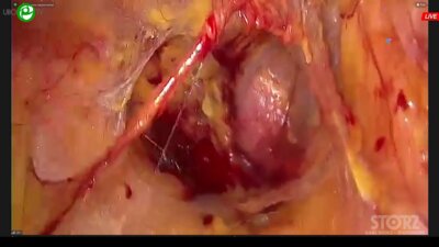 Галлямов Э.А. - Лапароскопическая простатэктомия