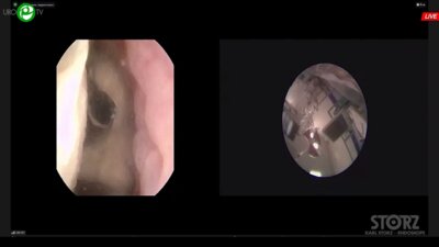 Гаджиев Н.К., Малхасян В.А. - Комбинированная интраренальная хирургия с использованием технологии миниперк