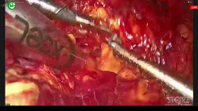 Котов С.В. - Лапароскопическая транскапсулярная аденомэктомия