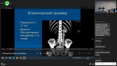 Истокский К.Н. - Лапароскопическая пластика мочеточника при мегауретре у взрослых