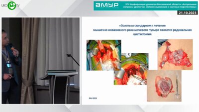 Кешишев Н.Г. - Лапароскопическая цистэктомия. За и Против