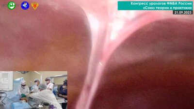 Вольных И.Ю. - Лапароскопический уретероцистоанастамоз