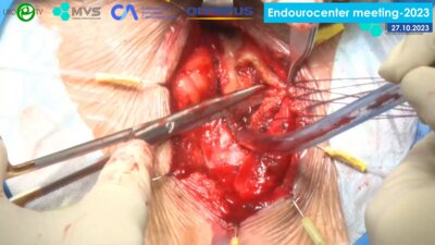 Котов С.В. - Транскорпоральная установка искусственного сфинктера мочевого пузыря