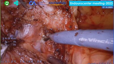 Мосоян М.С. - Робот-ассистированная нейросохраняющая радикальная простатэктомия (роботическая система da Vinci Si)