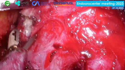 Топузов Т.М. - Ретроперитонеоскопическая аденомэктомия