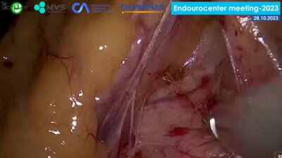 Галлямов Э.А. - Лапароскопическая пластика мочеточника