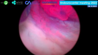 Носов А.К. - ТУР стенки мочевого пузыря с визуализацией в синем цвете (BLI)_1