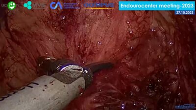 Аль-Аттар Т.Х. - Лапароскопическая аденомэктомия