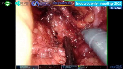 Медведев В.Л. - Робот-ассистированная резекция почки (роботическая система da Vinci Xi)